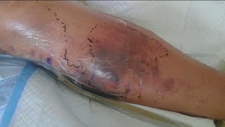 Rusty Nail Causes Necrotizing Fasciitis in Woman’s Leg