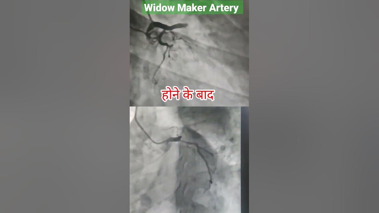 Lad 100 block widow maker artery sudden death shorts youtube