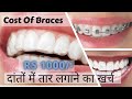 Teeth Braces Price & Cost In Delhi India, दांत सीधे करवाने का खर्च, Braces lagwane ka kharcha.