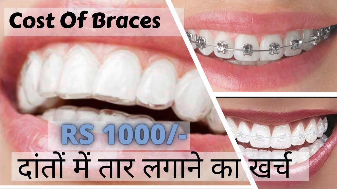 Best Dental Braces Starts @ Rs1000- Metal, Ceramic Braces