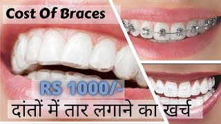 5 Main Types of Braces Available/Kalyani Nagar, by Jadhav Meenakshi