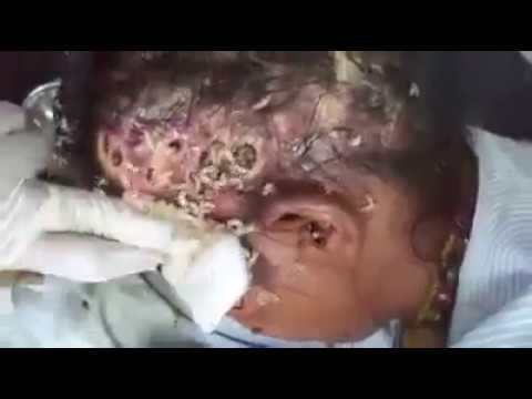 See How Maggots Feasted on this woman's Brain 