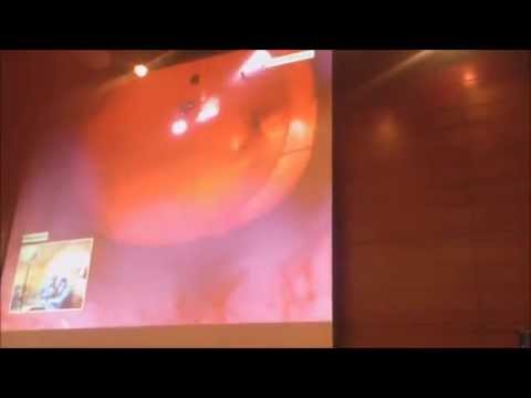 My first Live Surgery.\"Phacoemulsiphication\"Grigor Kamushadze.MD ფაკოემულსიფიკაცია,.გრიგოლ ქამუშაძე