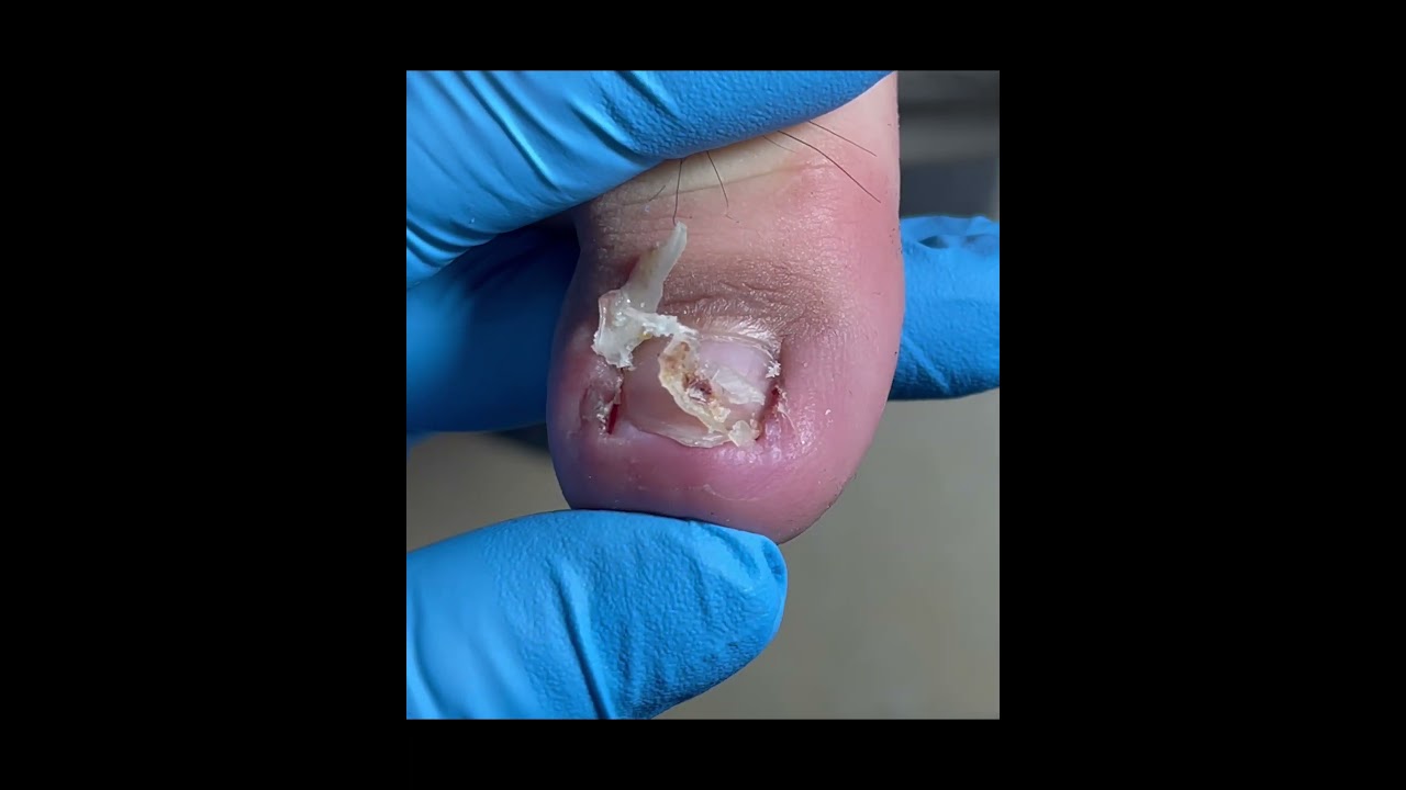 The Massive Armor Plating Was Slowly Separated! #nails