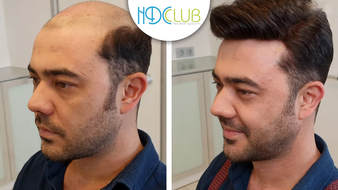 Para Iade Garantili Protez Sac Hair Replacement Hdc Club Youtube