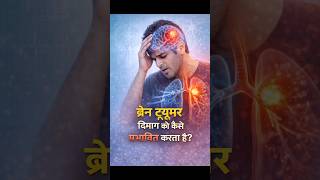 Brain tumor दिमाग को कैसे प्रभावित करता है 😱 #braintumortreatment
