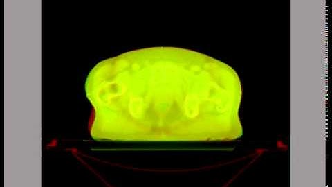 prostate rigid registration - axial