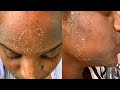 I GOT MY FIRST CHEMICAL PEEL! | Full Process + Results | Hyperpigmentation + Acne Scars