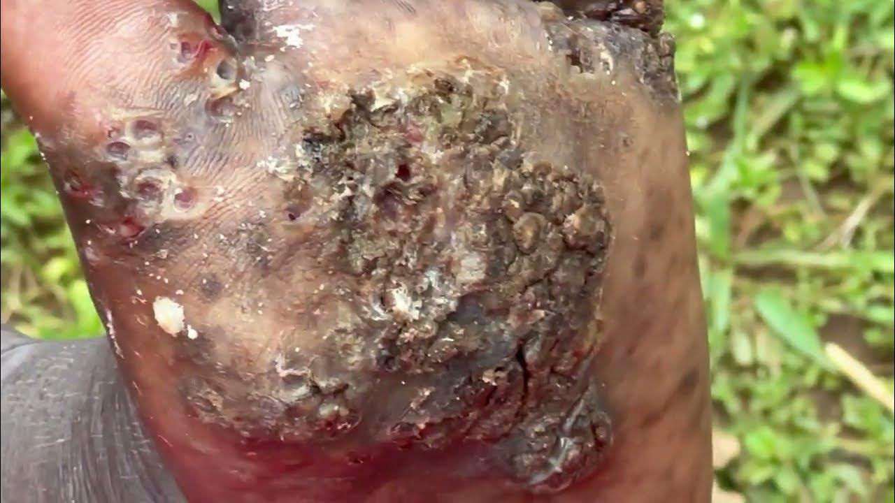 Felista's left foot jigger digging so many bugs and scales YouTube