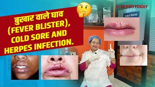 Fever blister cold sore and herpes infection
