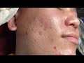 Acne Treatment Huong Da Nang# membership 017