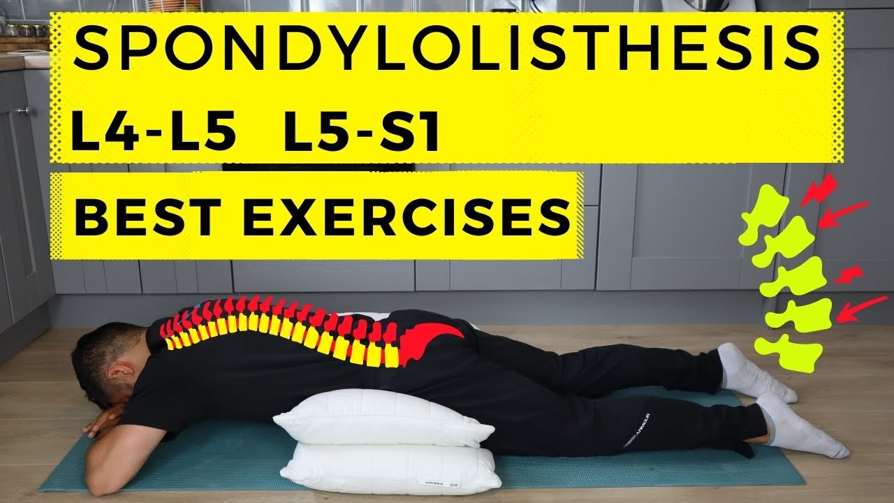 exercises for grade 1 spondylolisthesis