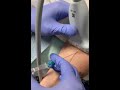 Ultrasound guided IV placement. 3/2021