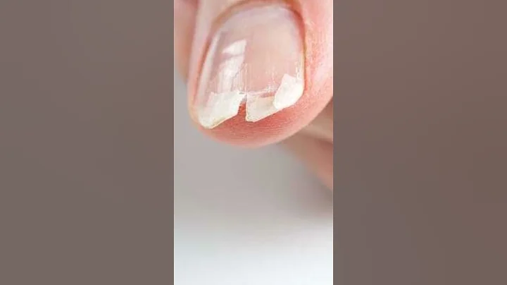 Nail Diagnostics: How Your Nails Reflect Your Inner Health!