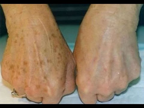 Соседка готовит крем, который помогает избавиться от "старческих" пятен ...