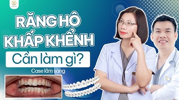 Răng Hô Khấp Khểnh Cần Làm Gì - Case Lâm Sàng Niềng Răng | Bác sĩ Trung Long Biên