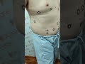Lipoma Lipoma Removal Multipal Lipoma Removal Short Shortvideo Lipoma Lipoma Removal Multipal Lipoma Removal Short Shortvideo