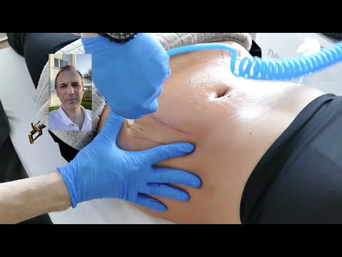 Video: Behandlung Von Schwangerschaftsstreifen Mit Volksheilmitteln Und -methoden