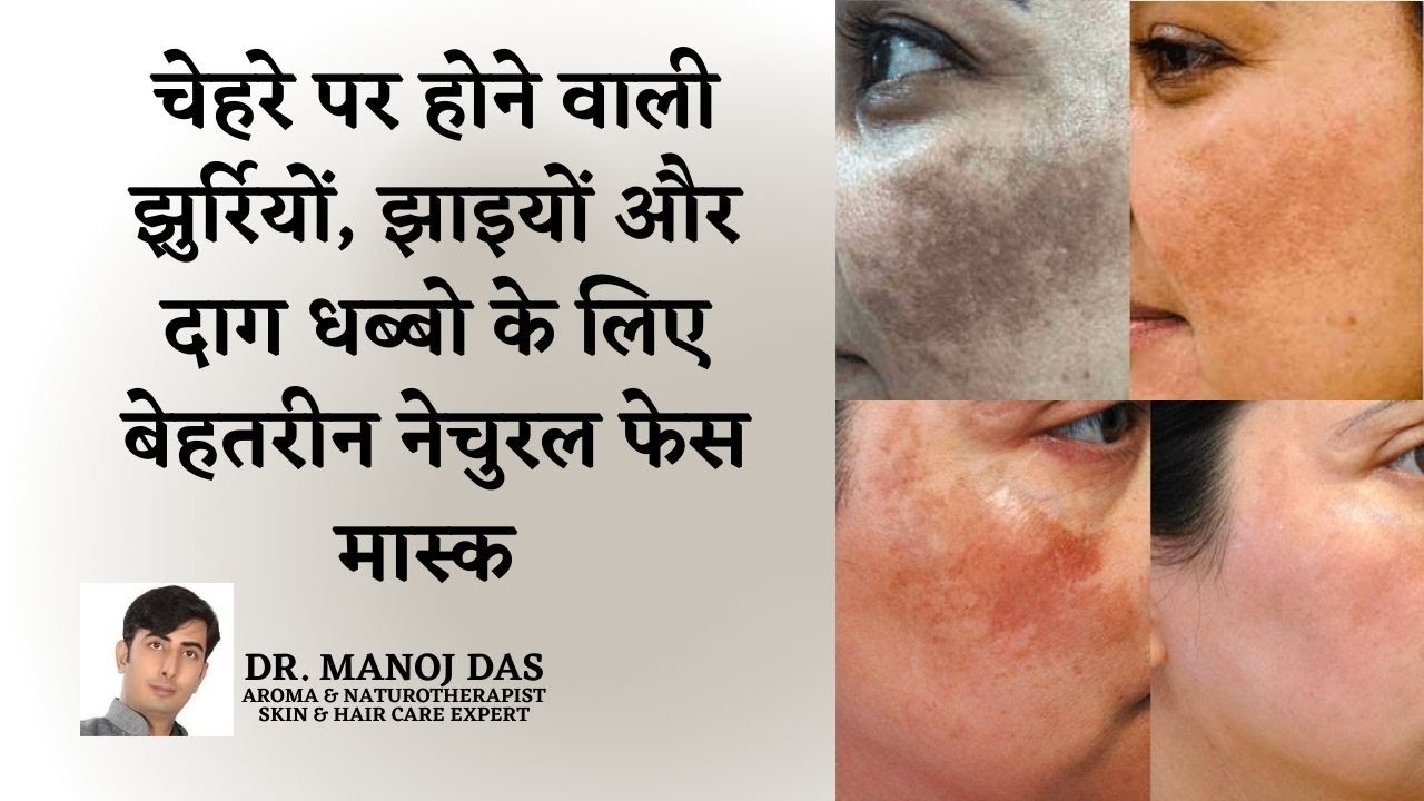 How To Get Rid of Hyper pigmentation I Freckles, Dark Spots, Melasma, Fast Naturally I DR. MANOJ DAS