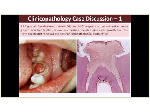Lab Session 5 & 6 Chronic Inflammation & TB, Actinomycosis