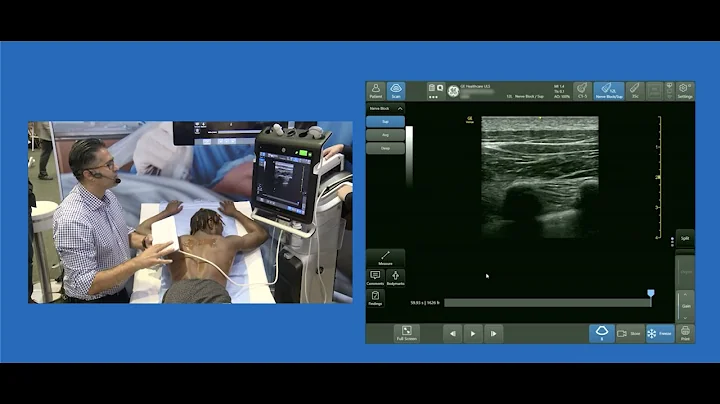 Paramedian Sagittal Approach to Thoracic Paraverte...