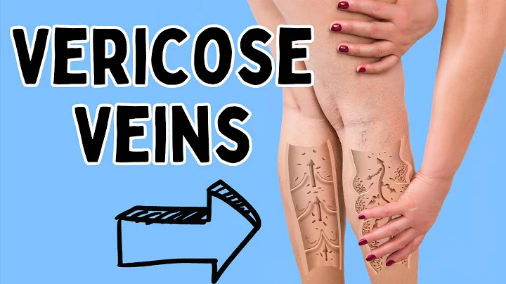 Twisted Troubles: Unraveling the Mystery of Varicose Veins