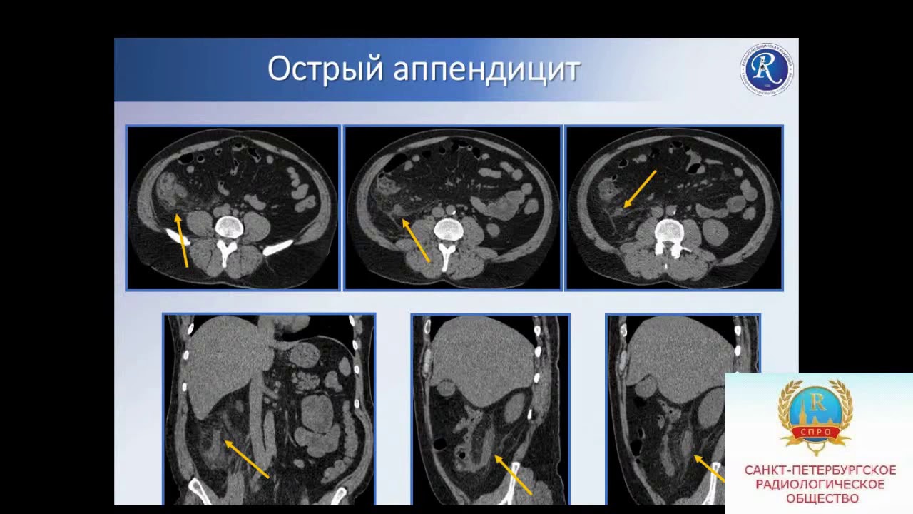 Как выглядит рак легких на кт фото