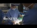 Inside the Complex Face Transplant Surgery: Part 2