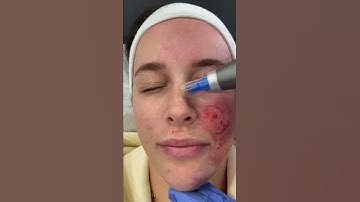 Micro-needling with Dermapen 4 at DRMEDISPA