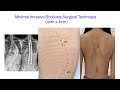 Mis scoliosis surgical technique