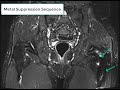 Mri hip metal suppression sequences showing