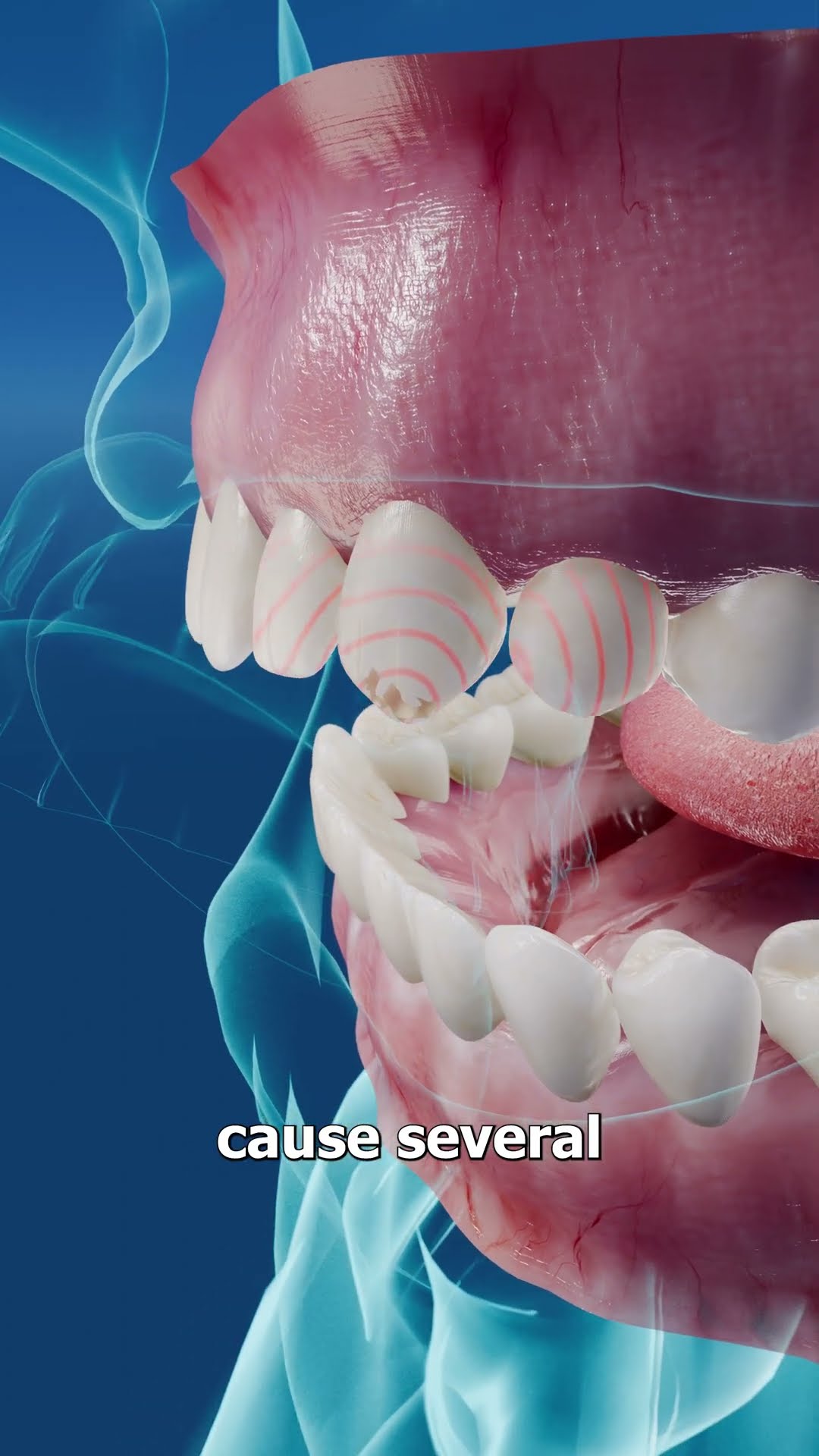 Opening Bottles With Your Teeth ?