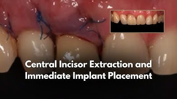 Central Incisor Extraction and Immediate Implant Placement