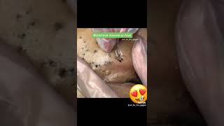 giant blackhead removal pimplepopping pimple pimpleremoval blackheads blackheadremoval
