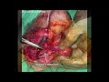 Hemithyroidectomy with a Vessel Sealer