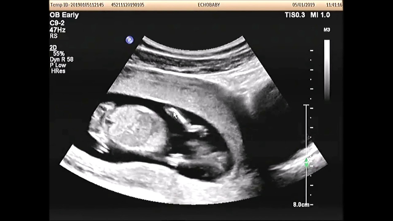 2D Echo 13 Weken Geslachtsbepaling, met ingesproken uitleg YouTube 2D Echo 13 Weken Geslachtsbepaling, met ingesproken uitleg YouTube