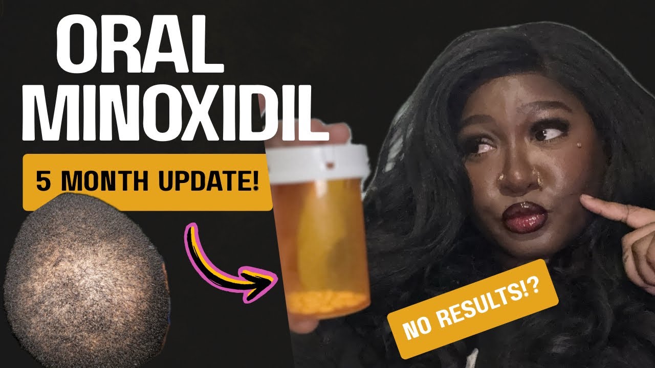 Oral Minoxidil Month 5: Is This Normal?