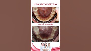 Thay đổi hàm răng khấp khểnh chen chúc | Bác sĩ Thu Gia Lâm