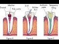 4 Root Canal Alternatives