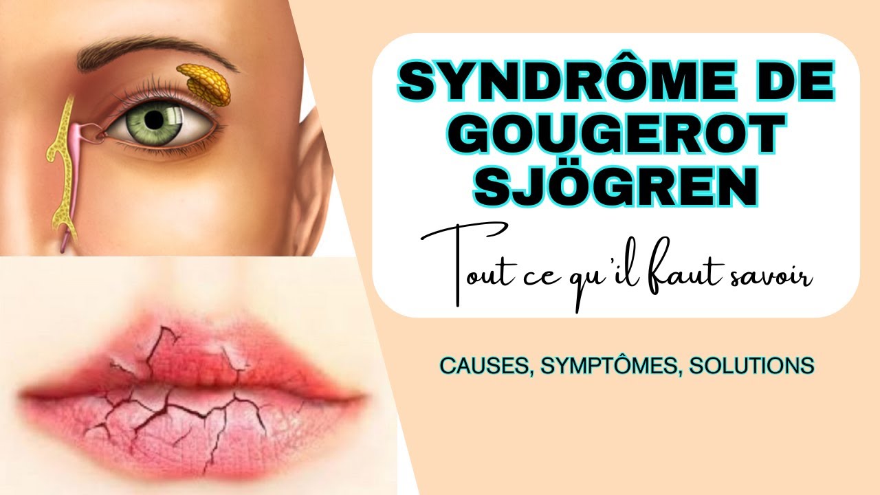 Syndrôme de Gougerot Sjögren : tout ce qu'il faut savoir (cause, symptômes, solutions)