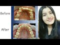 My Braces Experience - 22 Months