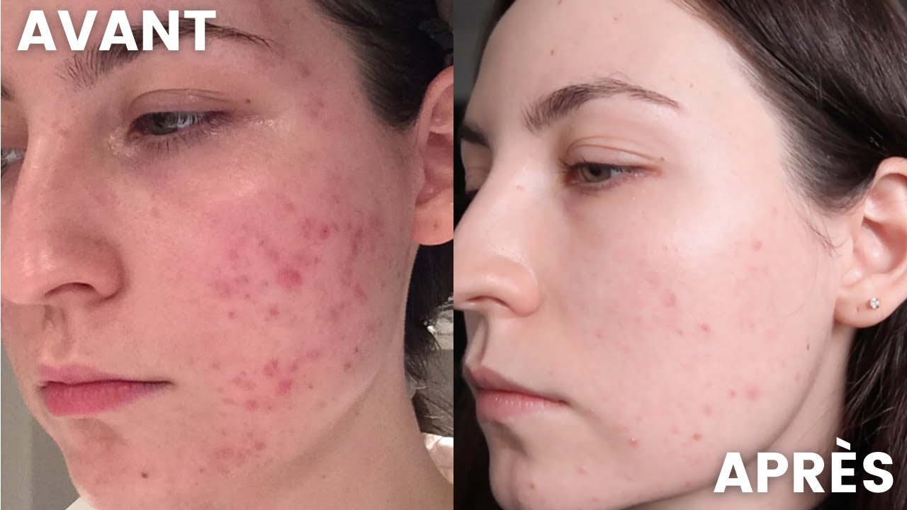 AVANT/APRÈS : COMMENT JE ME SUIS DÉBARRASSÉE DE MON ACNÉ (+  conseils)⎢ACNE.ORG