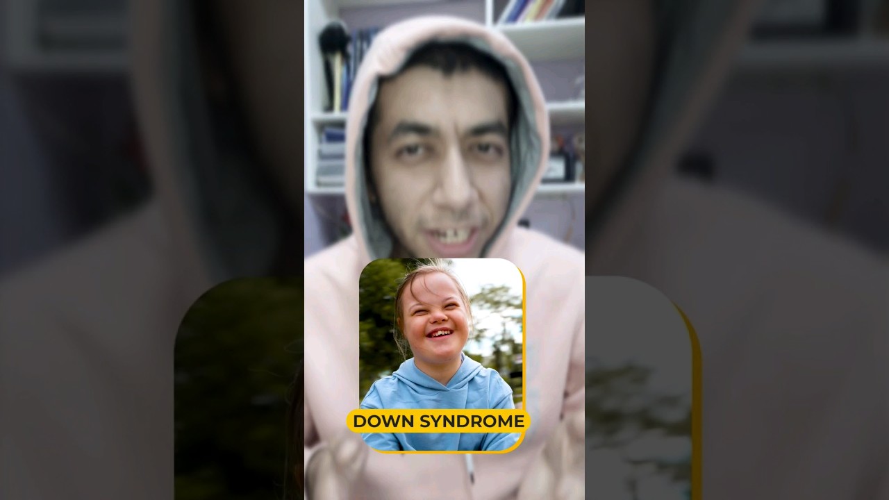 ليه متلازمة داون عمره قصير 🤔