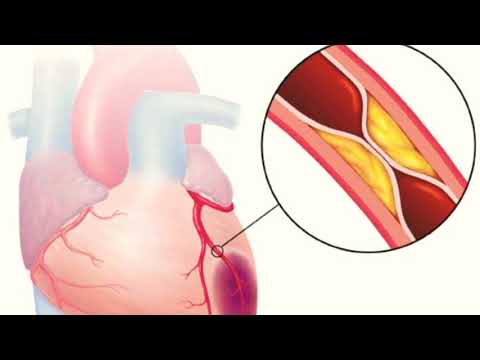 Video: Լոլիտան սրտի կաթված ստացավ