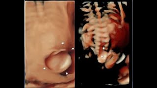 case of the week 10  Chiari II malformation
