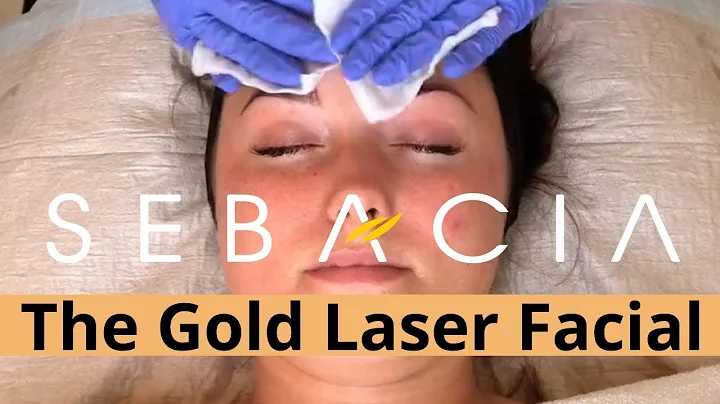 Sebacia™ Microparticle Yag Laser Treatment [New Accutane Alternative]