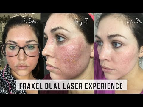 FRAXEL DUAL LASER TREATMENT FOR ACNE SCARS | DAY BY DAY RESULTS | KAILYN CASH