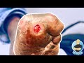 EXTREME DIABETIC CALLOUS REMOVAL ON DEFORMED FOOT