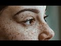 Freckles | Age-spots  LaserTreatment