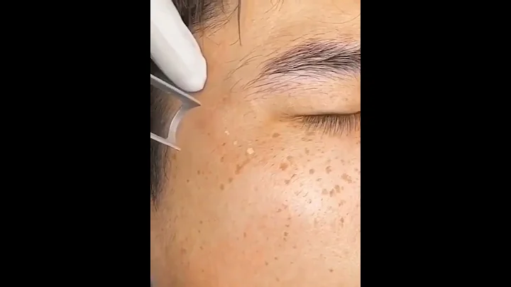 Freckles | Age-spots  LaserTreatment - DayDayNews